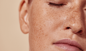 How to Remove Age Spots Naturally