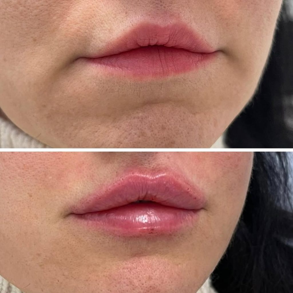 Lip Filler injection Before and After