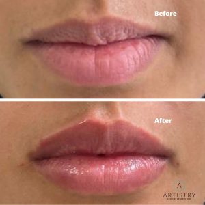 Lip Filler before and after