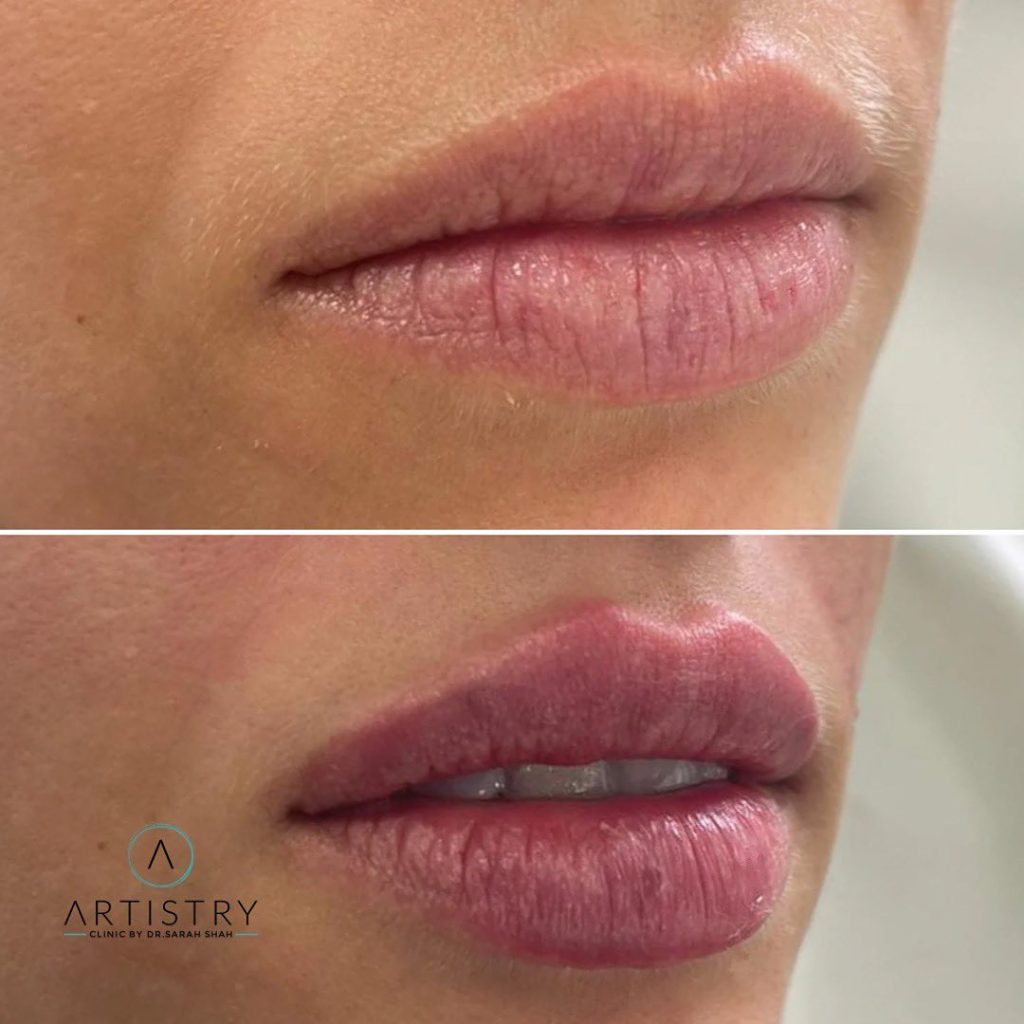 botox lip flip before and after