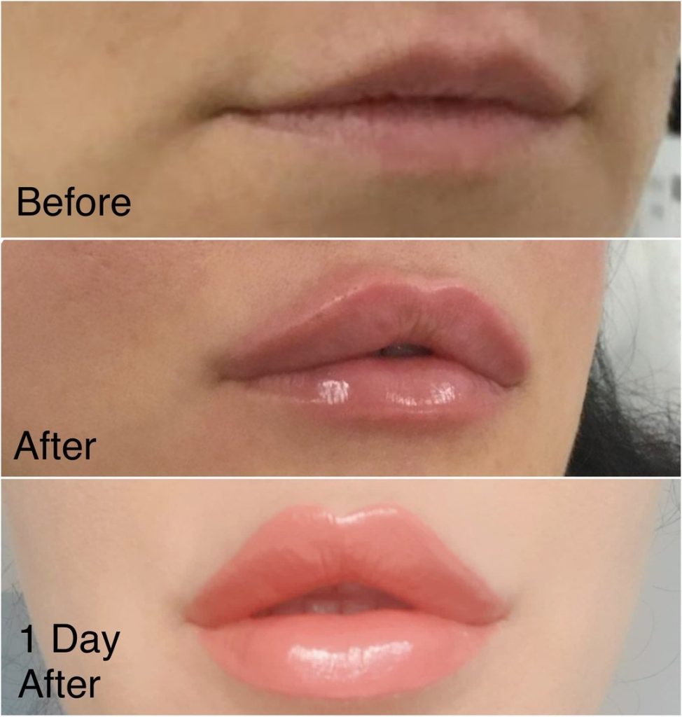 lip augmentation before and after