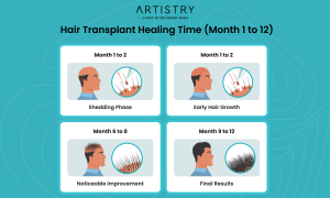 Hair Transplant Recovery Timeline What To Expect