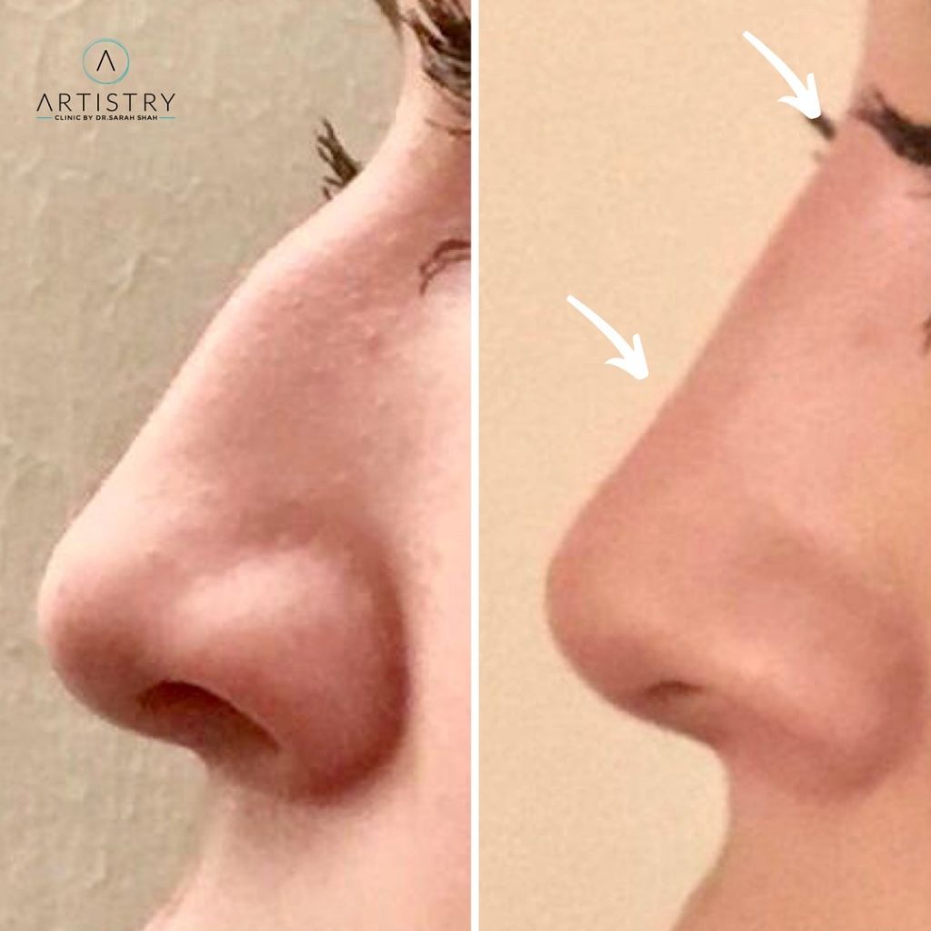 Non-Surgical Nose Reshaping