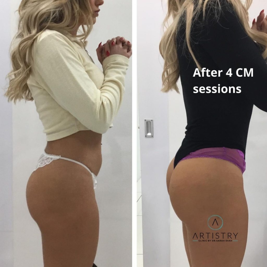 Butt Shape