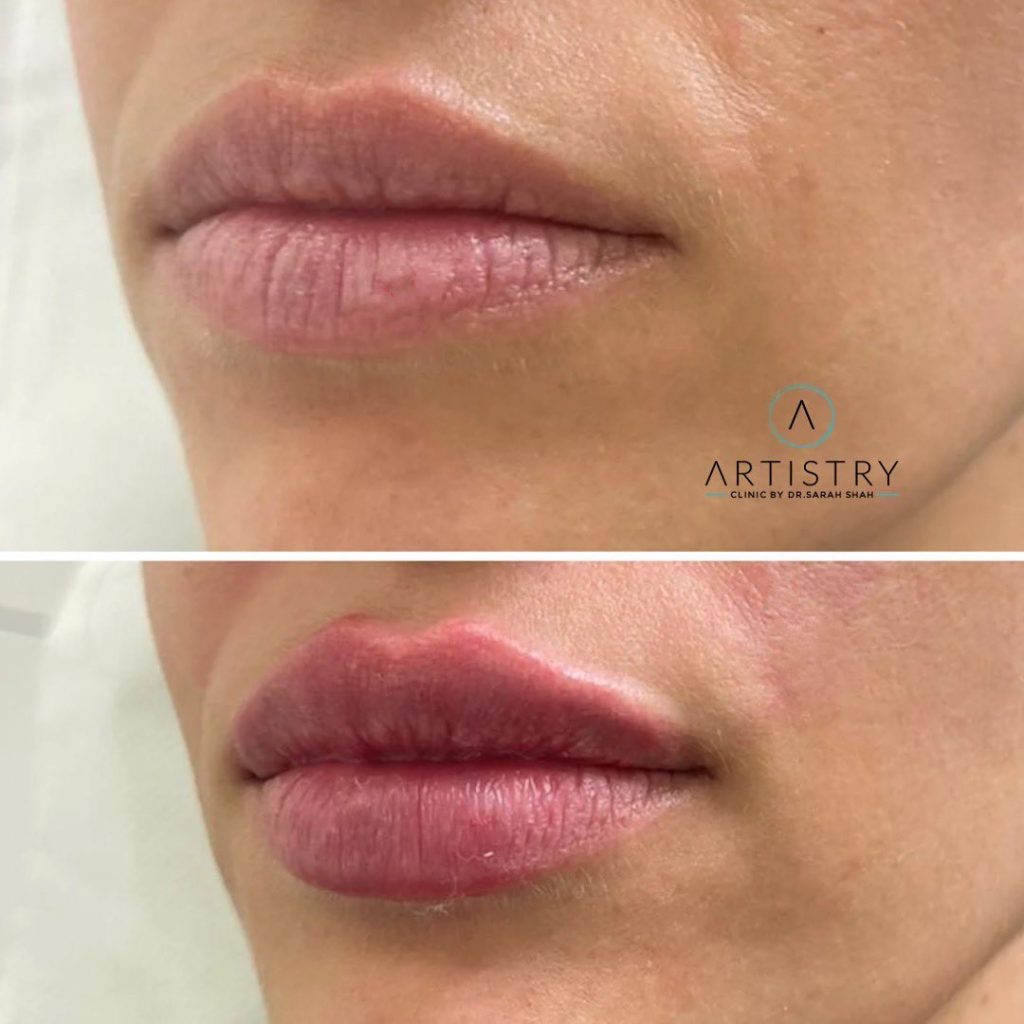 What is Juvederm Used For