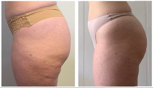 how to get rid of inner thigh fat