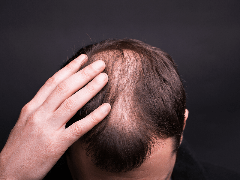 Hair Transplant Healing Time