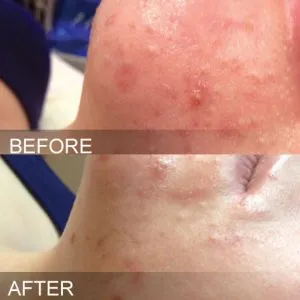 How to Get Rid of Open Pores on Face