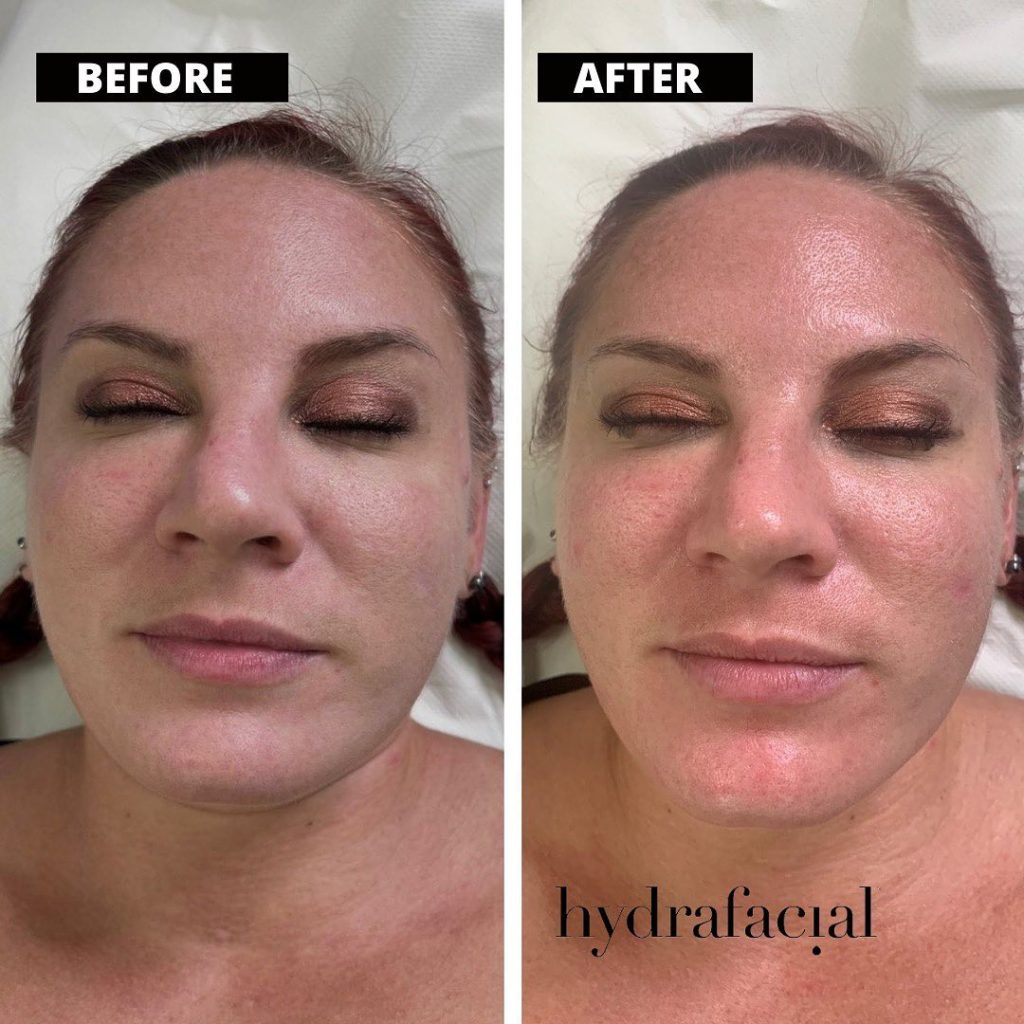 How to Reduce Pores in Face