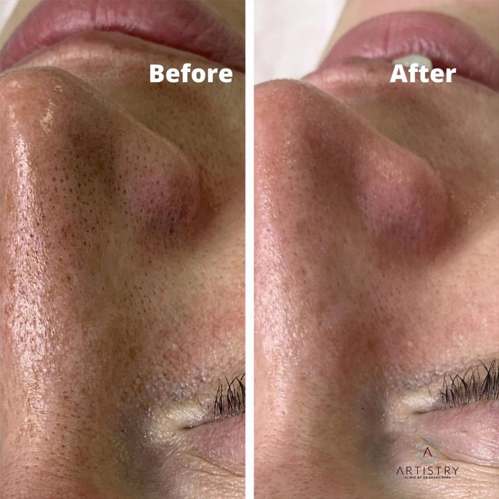 How to Reduce Pores in Face with Professional Treatments